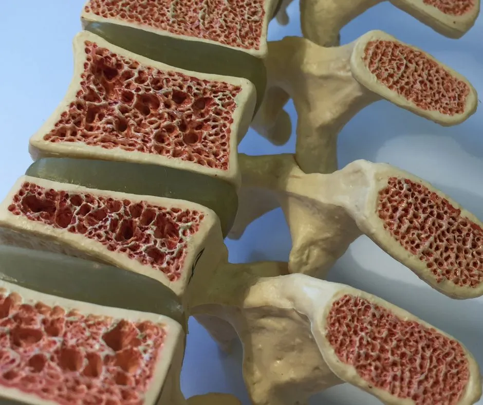 bone depicting osteoporosis caused by magnesium deficiency